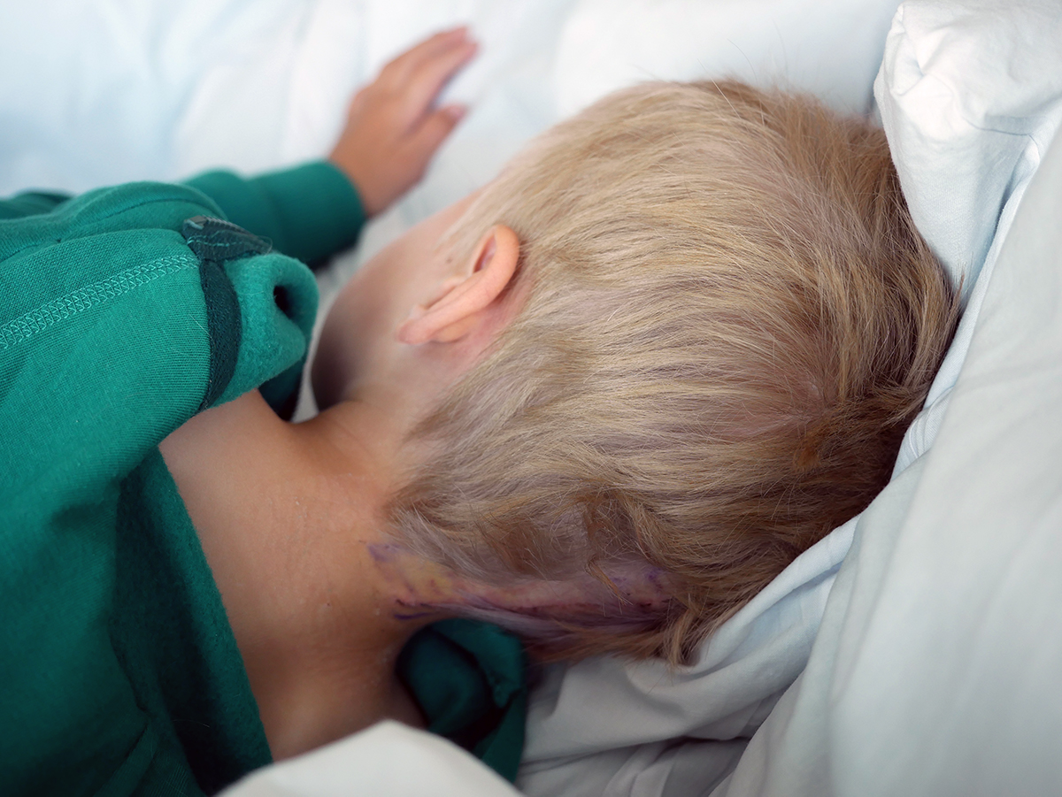 Elis nacke med ärret och pennmarkeringar från operationen.