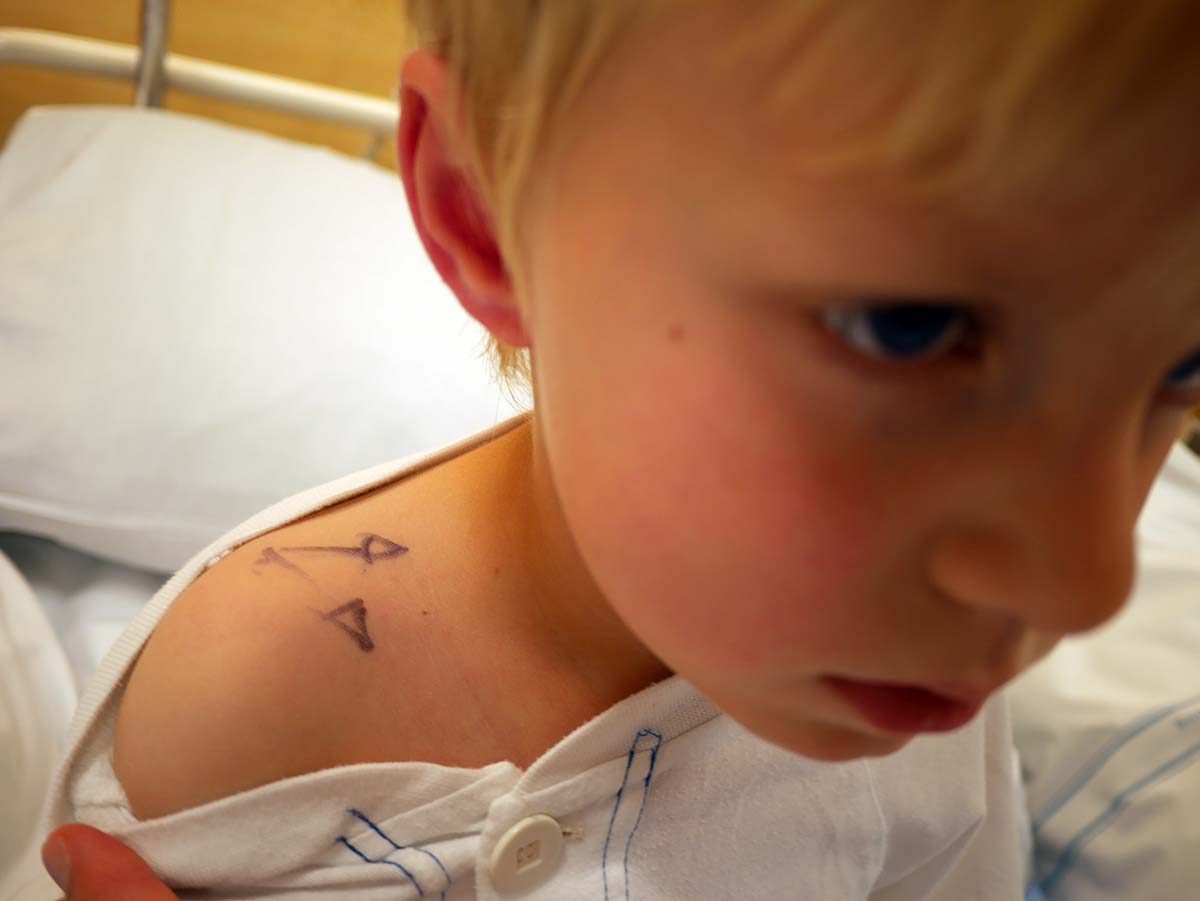 Markeringar på Elis axel visar hur de ska operera in venporten i morgon.