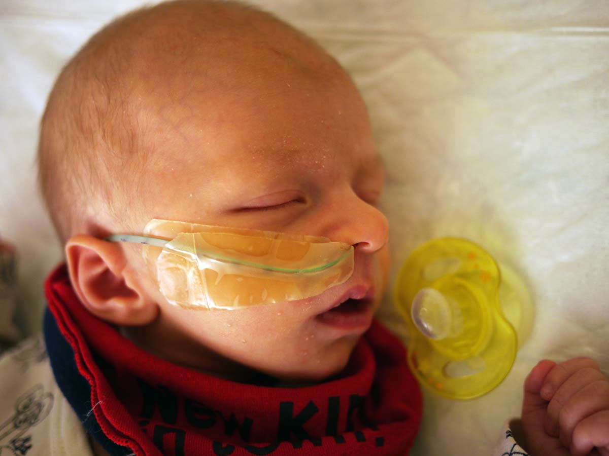 Elis, en månad gammal, med sond.