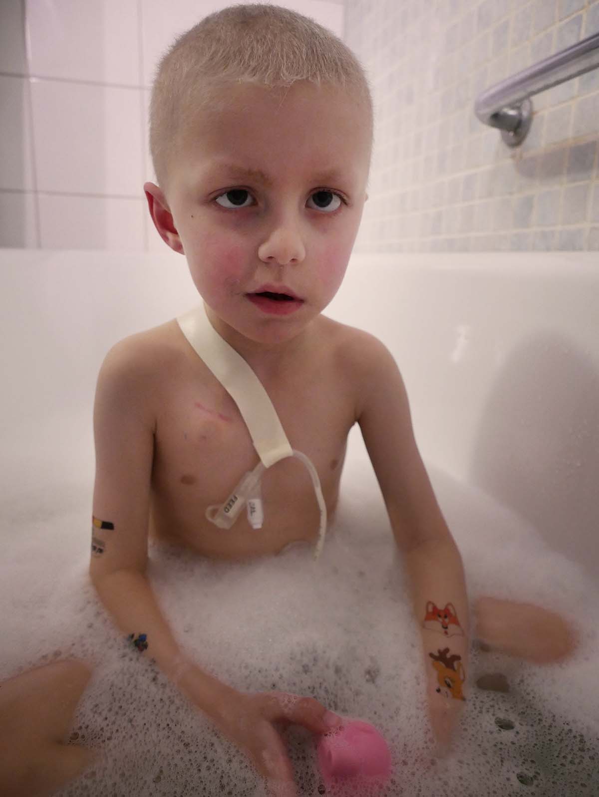 Elis i badet, med gastroslangen upptejpad mot axeln.