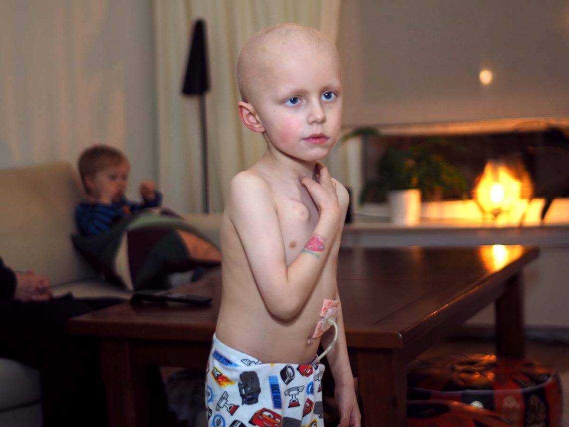 Elis med bar överkropp på kvällen, med sondslang och venportsdosa synliga