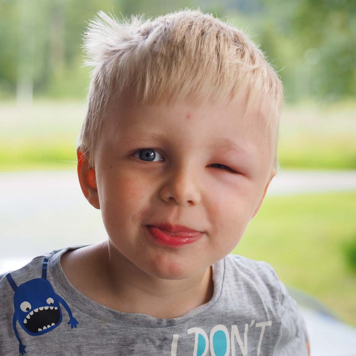 Elis innan sjukdomen, myggbiten vid ögat