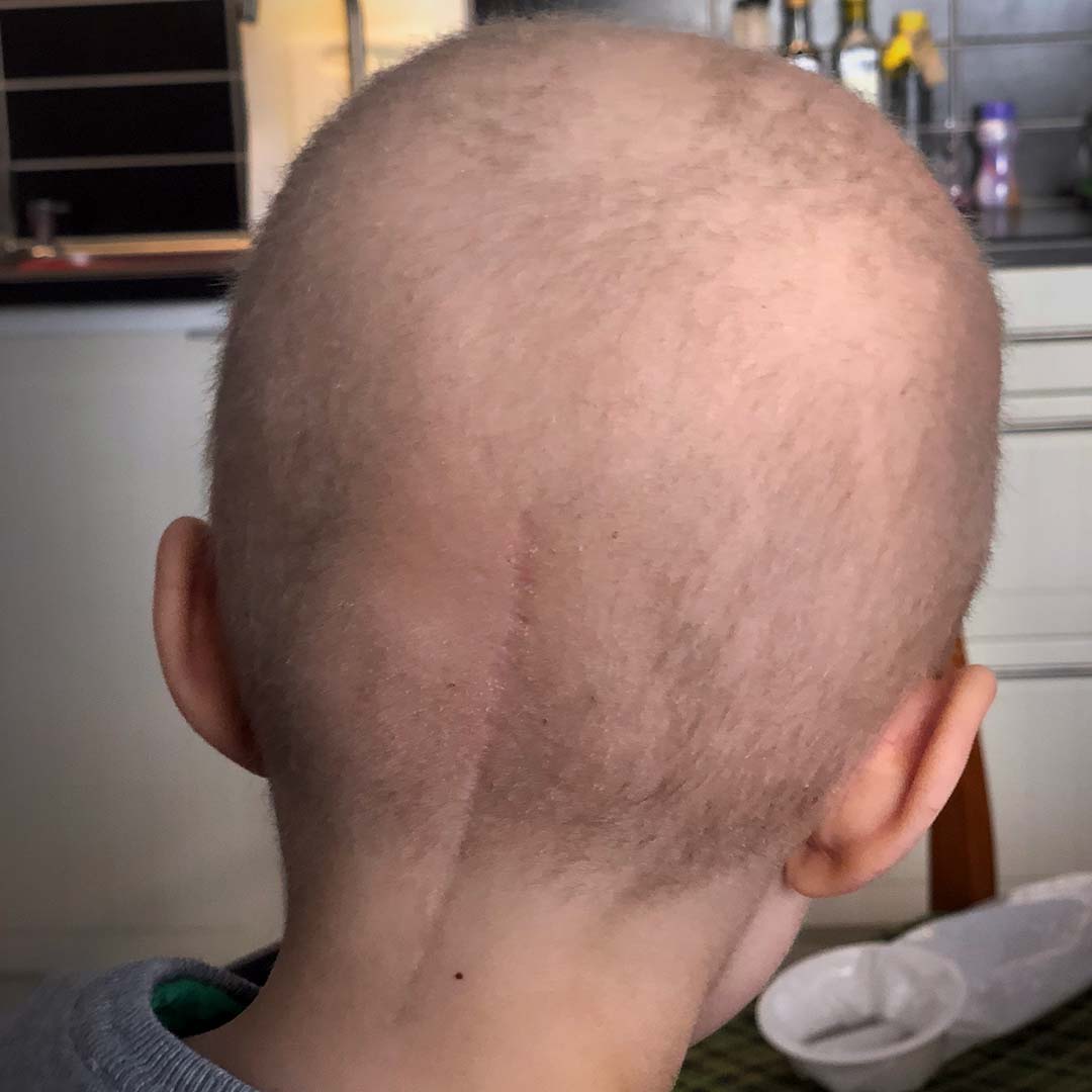 Elis nacke, med synligt operationsärr