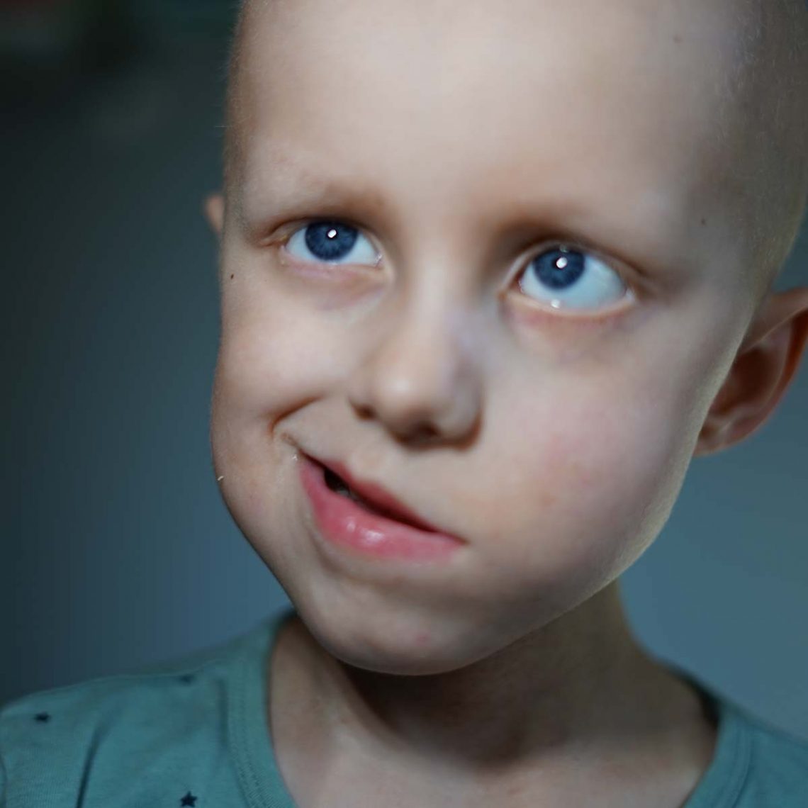 Elis ler, med ansiktsförlamningen tydlig