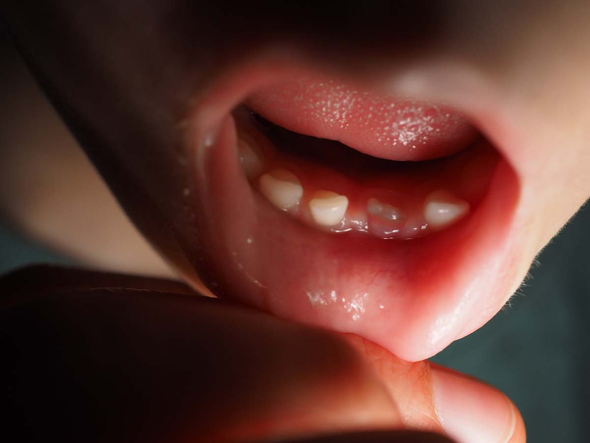 Elis första vuxentand tittar upp i underkäken