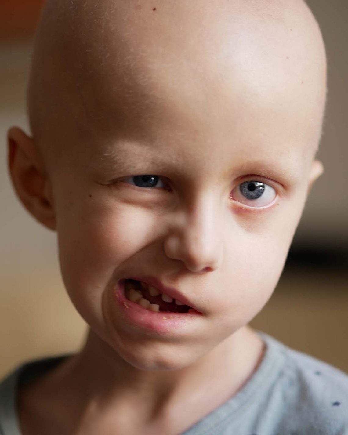 Elis försöker le, vilket är svårt med ansiktsparesen