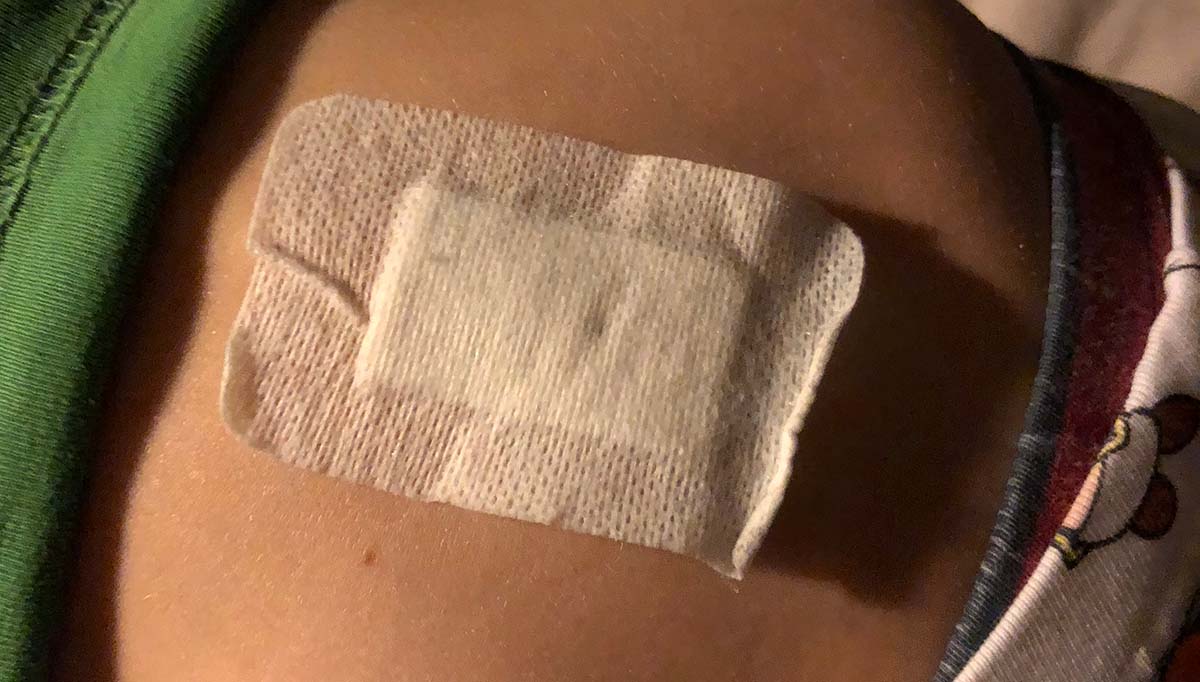 Kompressen i Elis svank efter lumbalpunktionen