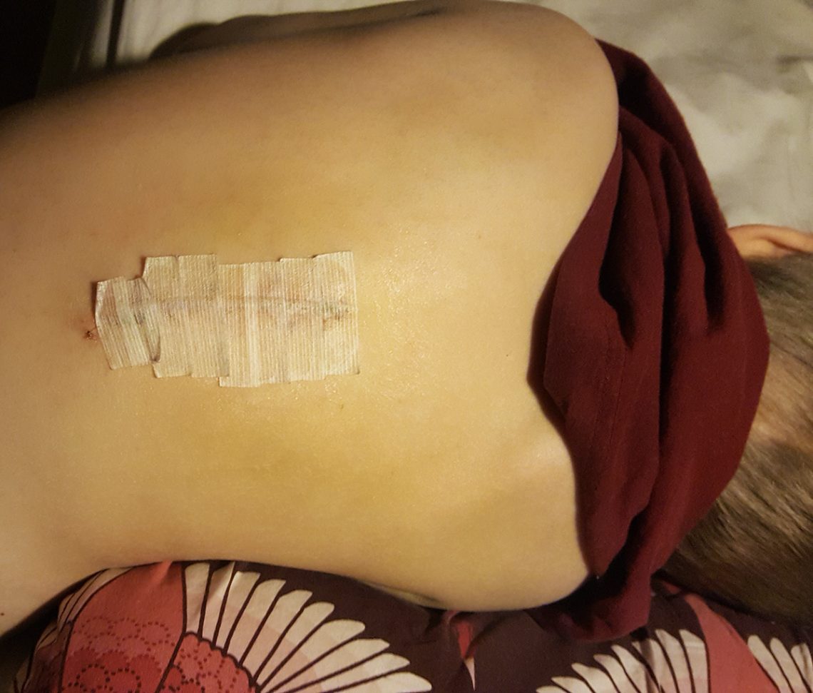 Elis ärrade rygg, två veckor efter operationen då den största tumören togs bort